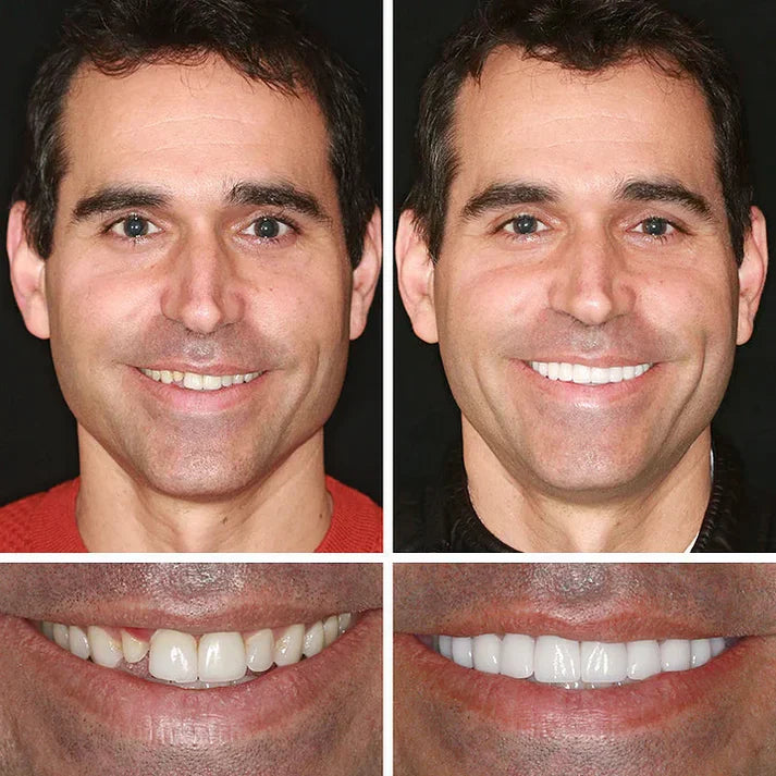 🔥3,155 sold in last 24 hours🔥⏰ Medical Full Denture with Strong Suctiond🦷Obtain American Dental Association (ADA) Certification