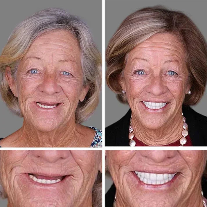 🔥3,155 sold in last 24 hours🔥⏰ Medical Full Denture with Strong Suctiond🦷Obtain American Dental Association (ADA) Certification
