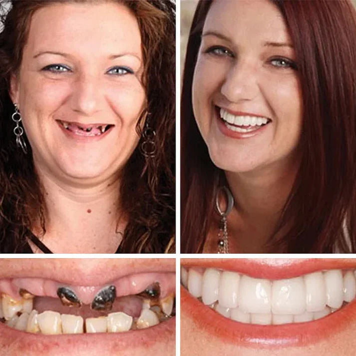 🔥3,155 sold in last 24 hours🔥⏰ Medical Full Denture with Strong Suctiond🦷Obtain American Dental Association (ADA) Certification